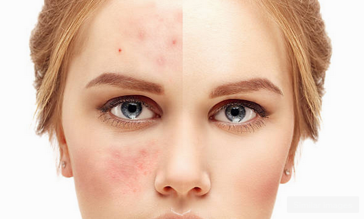 Acne and Lightening Skin